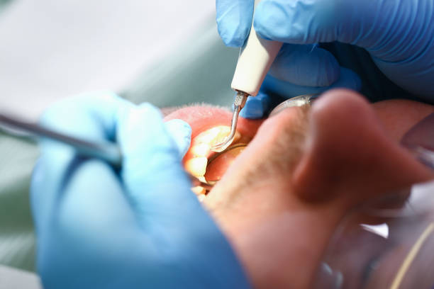 Best Emergency Wisdom Tooth Extraction in Afton, MN
